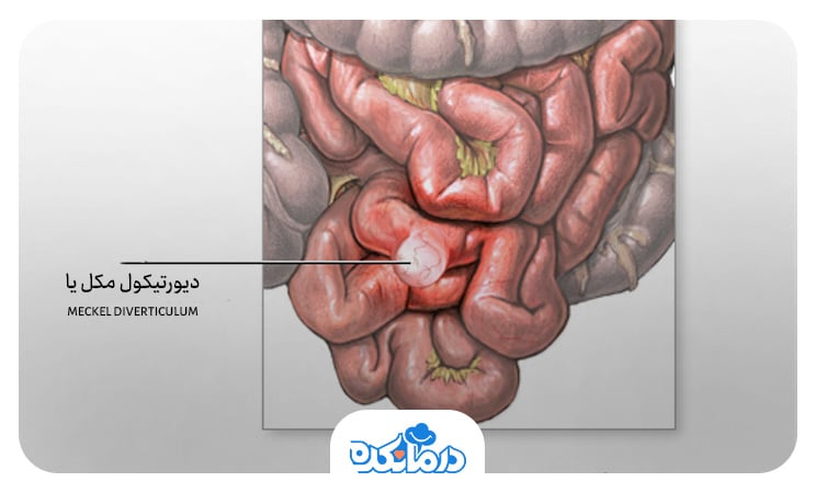 تصویری از دیورتیکول مکل