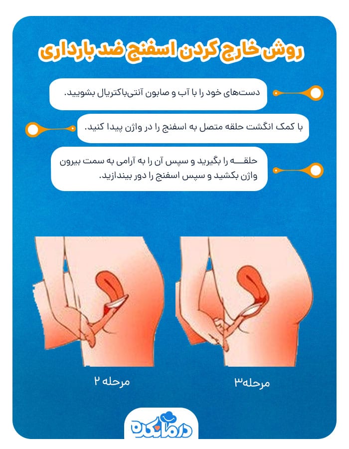 اینفوگرافی روش خارج کردن اسفنج ضد بارداری