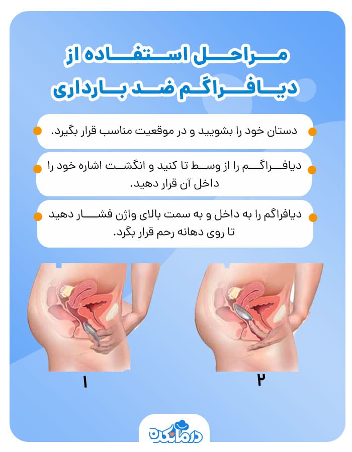 اینفوگرافی مراحل استفاده از دیافراگم ضد بارداری