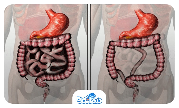 تصویر فردی که سندرم روده کوتاه را نشان می‌دهد.