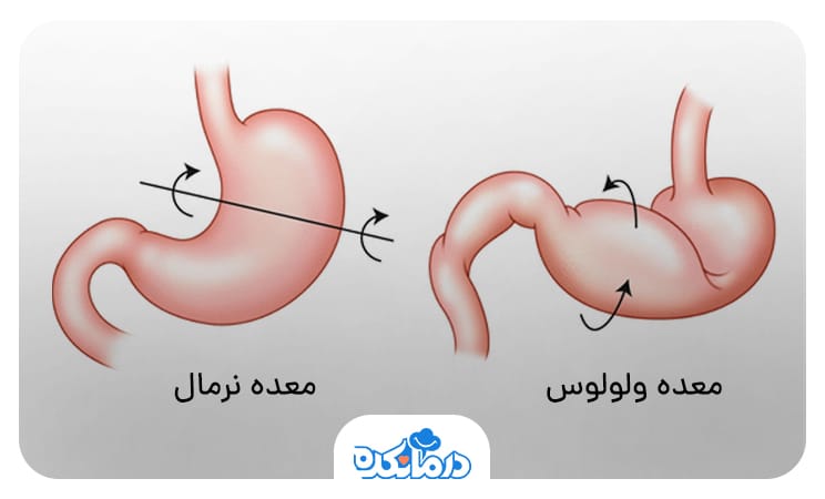 تصویر معده سالم و دارای ولولوس