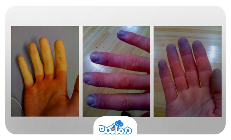نمایی از انگشت‌های سه دست که به دلیل پدیده رینود تغییر رنگ داده‌اند