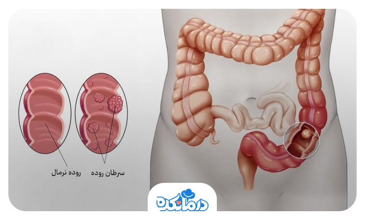 تصویری از آناتومی روده دارای تومور