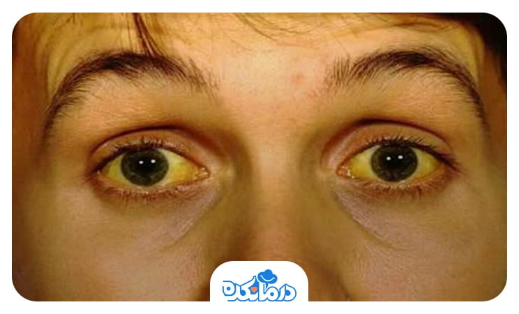 تصویر فردی که به هپاتیت a مبتلا شده و رنگ صورت و چشم‌های او زرد است.