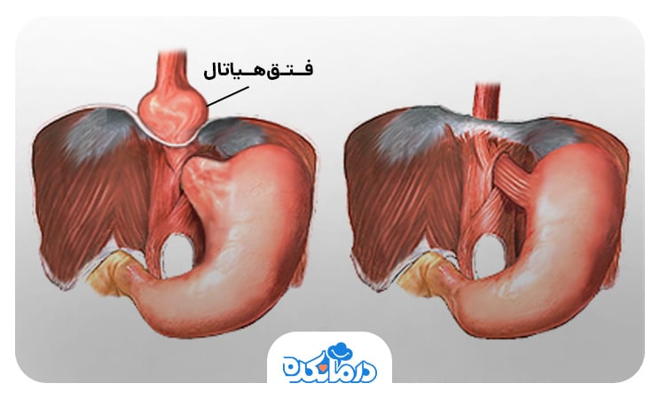 تصویری از فتق هیاتال