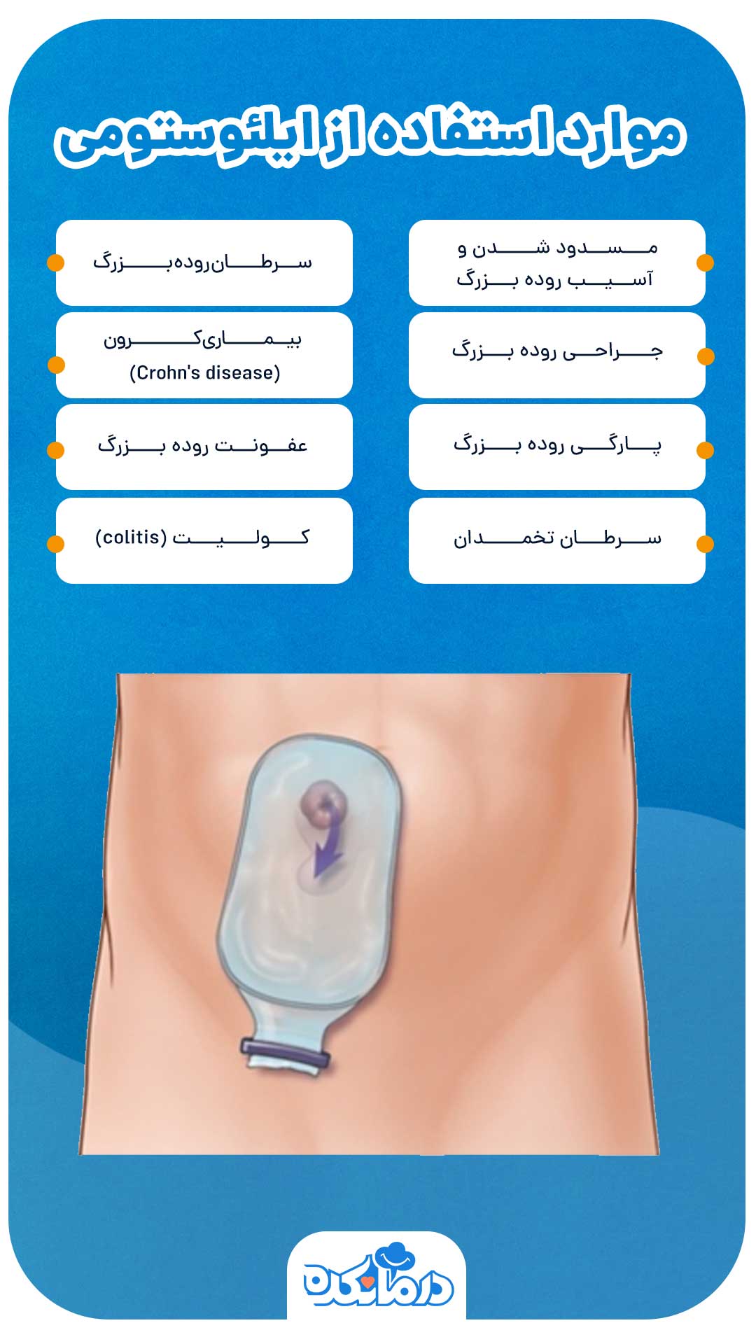 اینفوگرافی موارد استفاده از ایلئوستومی