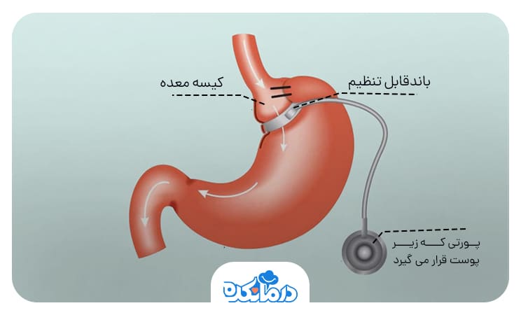 تصویر باندینگ معده