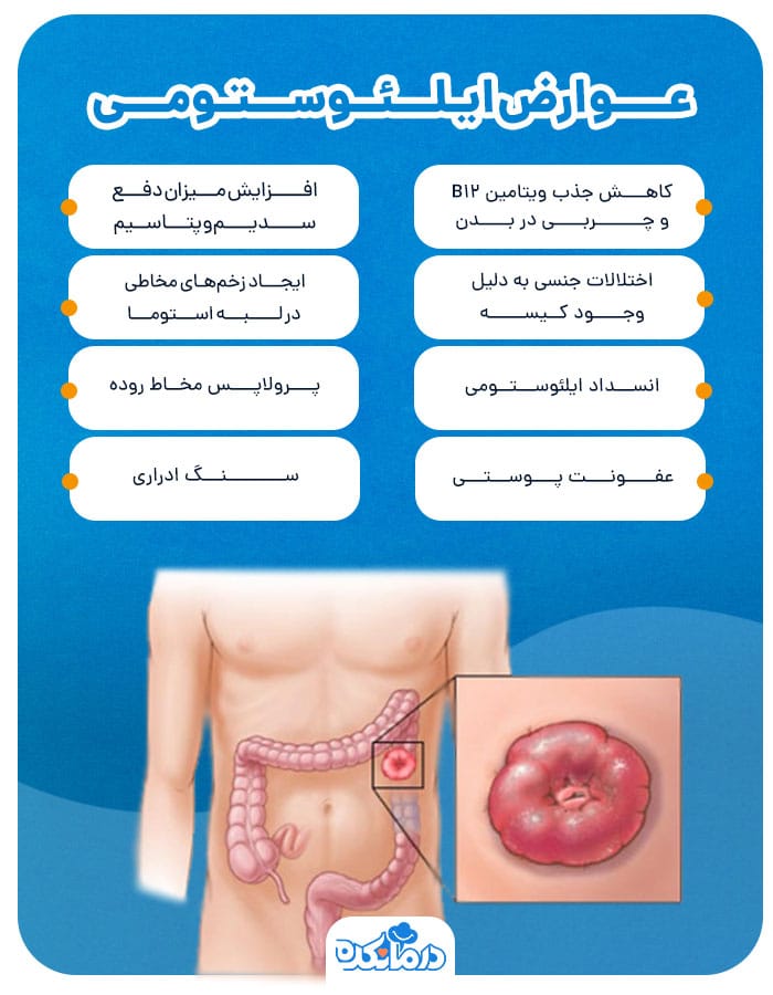 اینفوگرافی عوارض ایلئوستومی