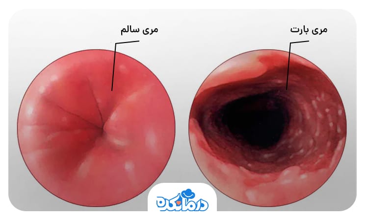 دو تصویر یکی از مری سالم و دیگری از مری ملتهب