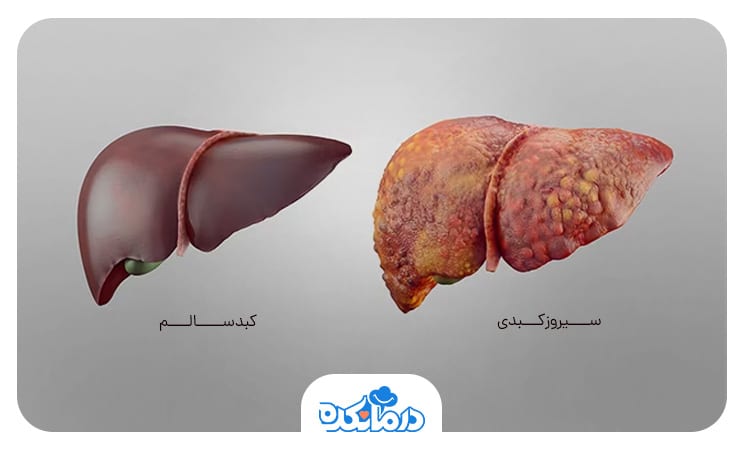 2 کبد که یکی سالم و دیگری به سیروز مبتلا است