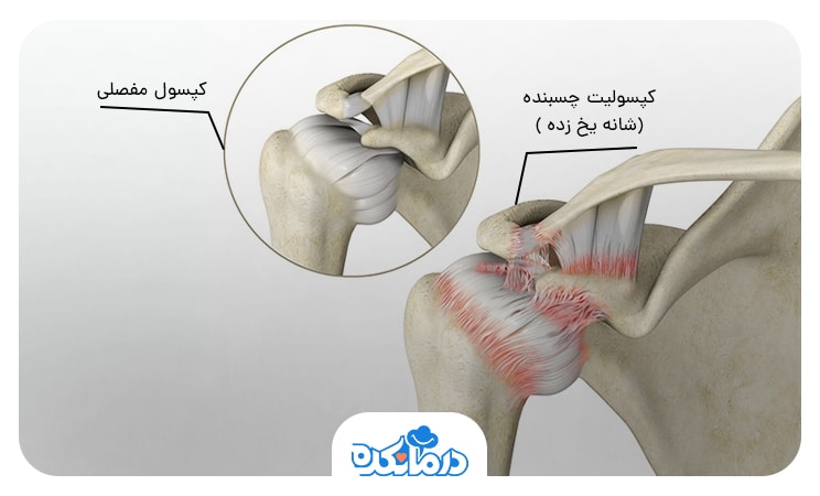 تصویر کپسولیت چسبنده یا شانه یخ زده