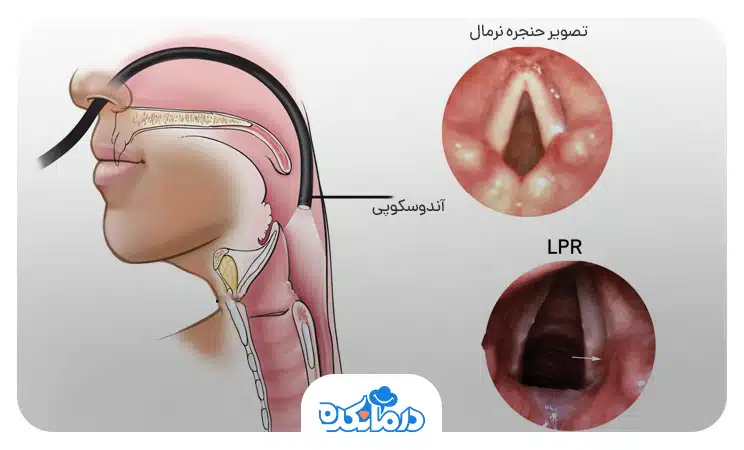 لارنژیت رفلاکس؛ درباره التهاب حنجره ناشی از رفلاکس اسید چه می‌دانید؟