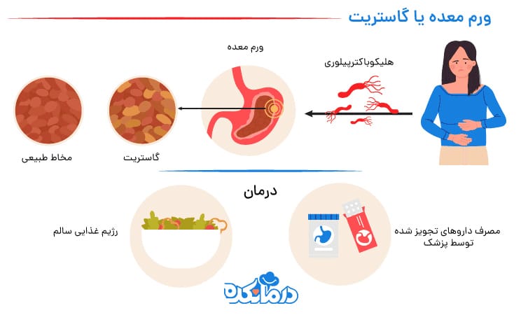 تصویری از فرآیند ابتلا تا درمان ورم معده یا گاستریت