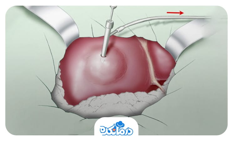 تصویری از آسپیراسیون برای تخلیه کیست