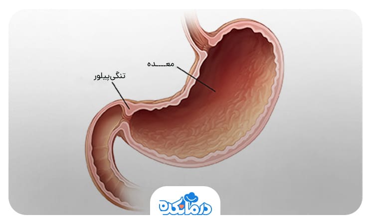 تصویر تنگی پیلور در انتهای معده