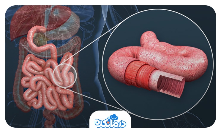 تصویری از التهاب رودهٔ کوچک که می‌تواند ناشی از انتروپاتی (Enteropathy) باشد