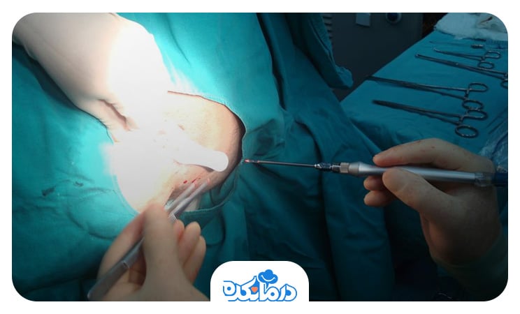 پزشکی که در حال جراحی فیستول با لیزر است