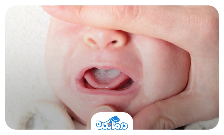 تصویر نوزادی که زبانش سفید است.
