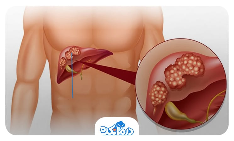 تصویری از آدنوم‌های کبدی، liver adenoma