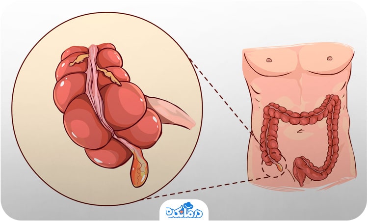 تصویری از جایگاه آپاندیس درون فضای شکمی. 