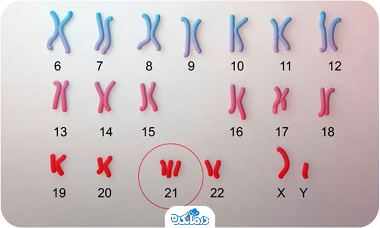 تصویری از کروموزوم فرد مبتلا به سندروم داون