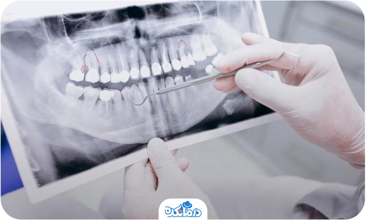 پزشکی که در حال بررسی عکس رادیوگرافی بیمار مبتلا به عفونت دندان است
