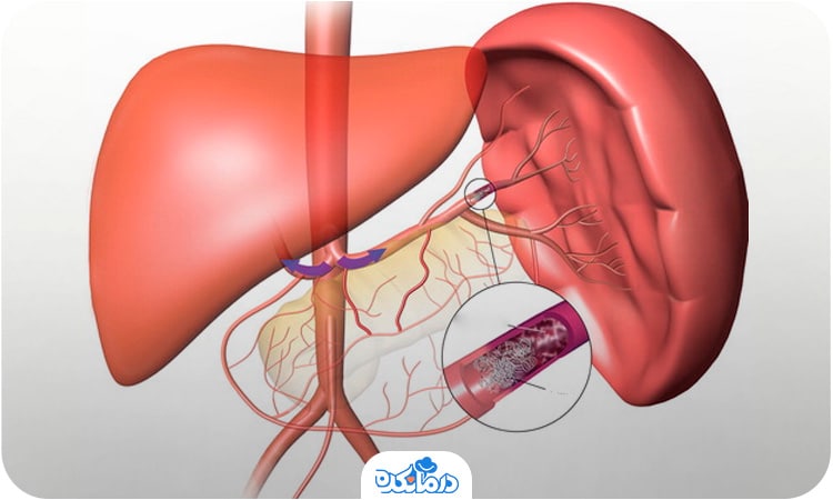 آسیب شریان طحال را می‌بینید که زمینه را برای انفارکتوس طحال مهیا می‌‌کند.