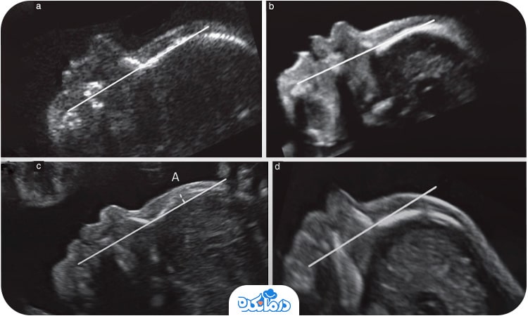 تصویر جنین مبتلا به سندروم داون