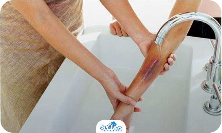 فردی که دستش دچار سوختگی درجه دو شده است. او برای بهبود آن، دست خود را زیر آب خنک گرفته است.