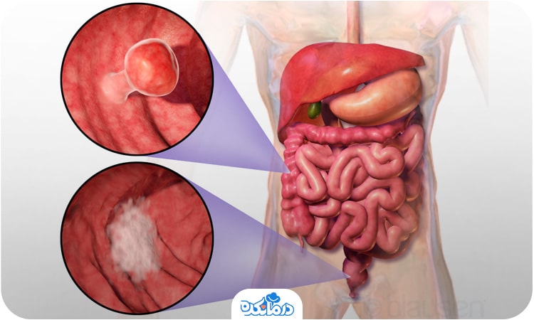 تصویری از سرطان کولورکتال که می‌تواند با خون در مدفوع همراه باشد.