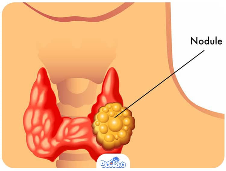ندول‌های غدهٔ تیروئید را می‌بینید.