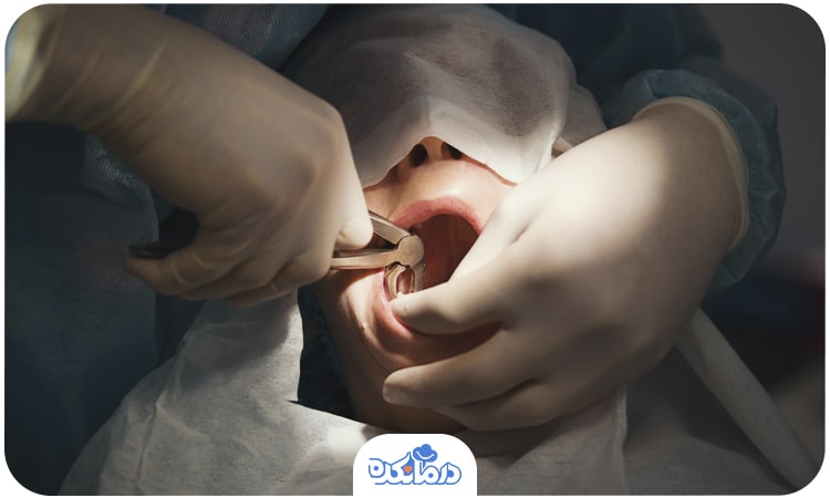 بیمار دهان خود را باز کرده و دندانپزشک در حال کشیدن دندان عقل او است