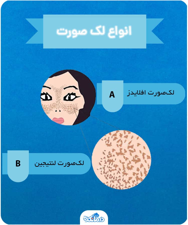 اینفوگرافیک انواع لک‌صورت