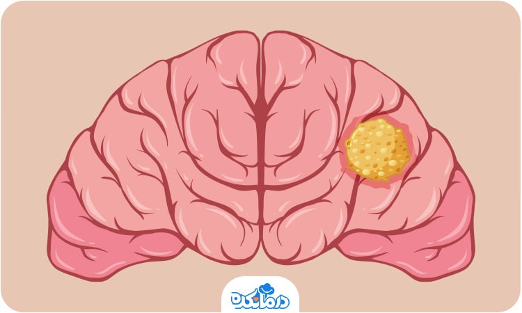 تصویر تومور یکی از دلایل ضایعه مغزی