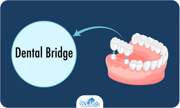 تصویر سه عدد بریج دندان که جایگزین سه دندان از دست رفته می‌شوند