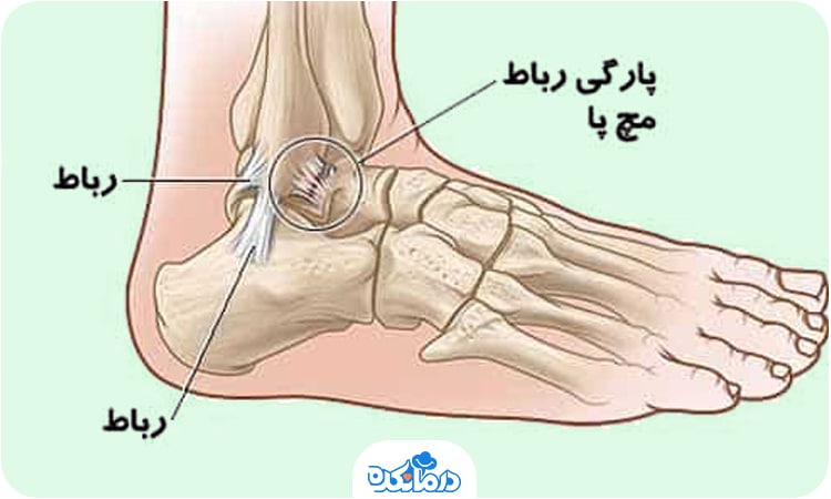 تصویر آناتومی مچ پا و علت بروز درد در آن