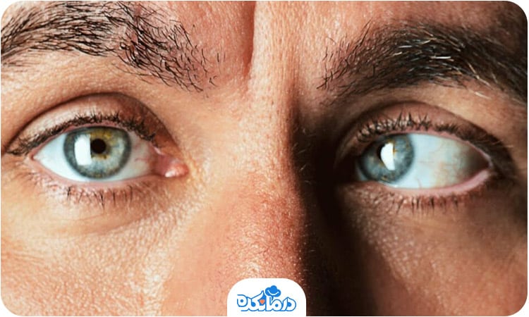 تصویری از فرد مبتلا به انحراف چشم