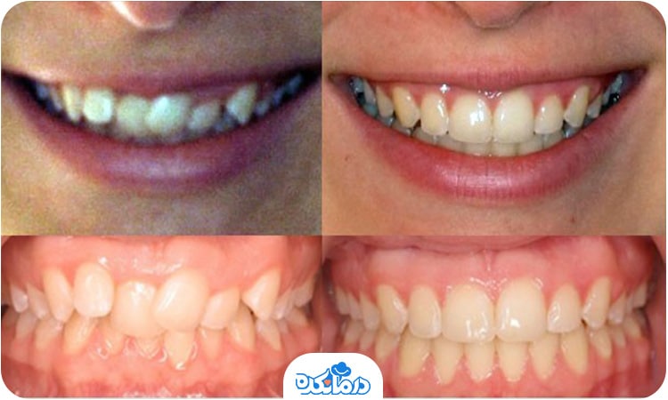 تصویر دندان‌ها قبل و بعد از استفاده از ارتودنسی متحرک