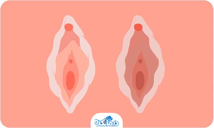 تصویری از تفاوت واژن سفید و تیره