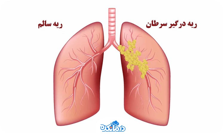 تصویری از ریه سالم و درگیر سرطان