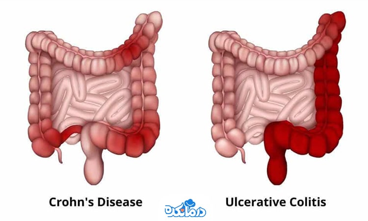 تصویری گرافیکی از کولیت اولسراتیو و کرون را می‌بینید که نوعی بیماری التهابی روده در کودکان هستند.