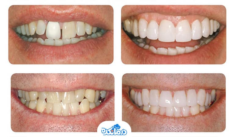 تصویر لمینت سرامیکی دندان قبل و بعد