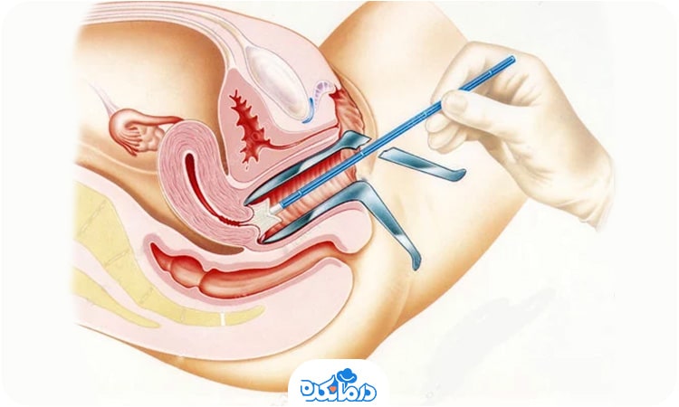تصویر گرافیکی از ورود اسپکولوم و بررسی دهانه رحم
