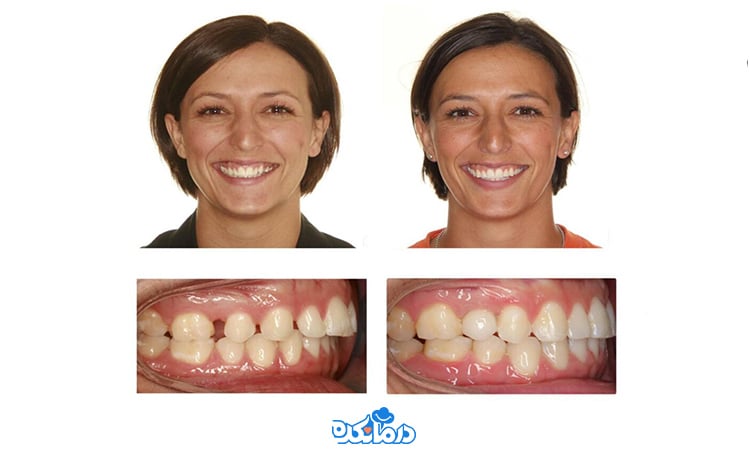 تصویر ارتودنسی دندان فاصله‌دار قبل و بعد