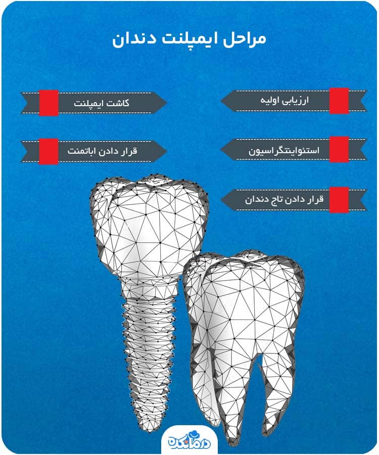 اینفوگرافیکی که مراحل ایمپلنت دندان را نشان می‌دهد.