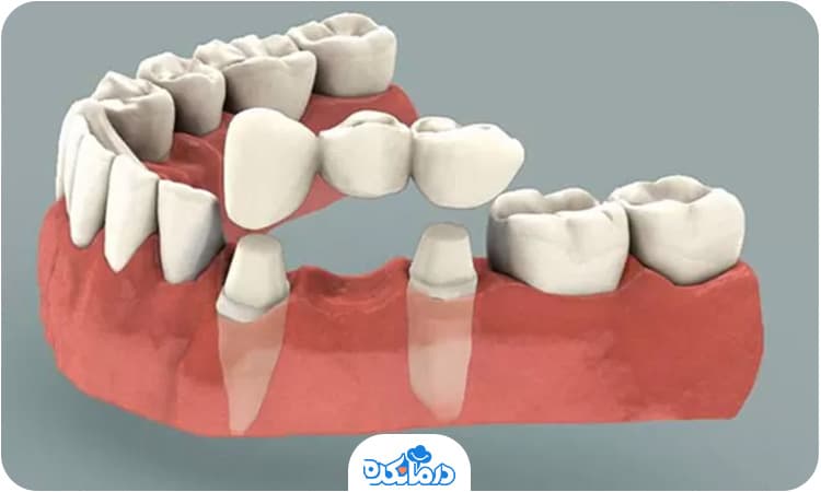 کاشت دندان به روش بریج دندانی را می‌بینید.