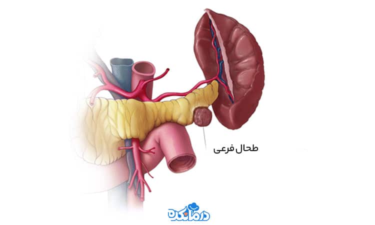 تصویر گرافیکی از طحال جانبی