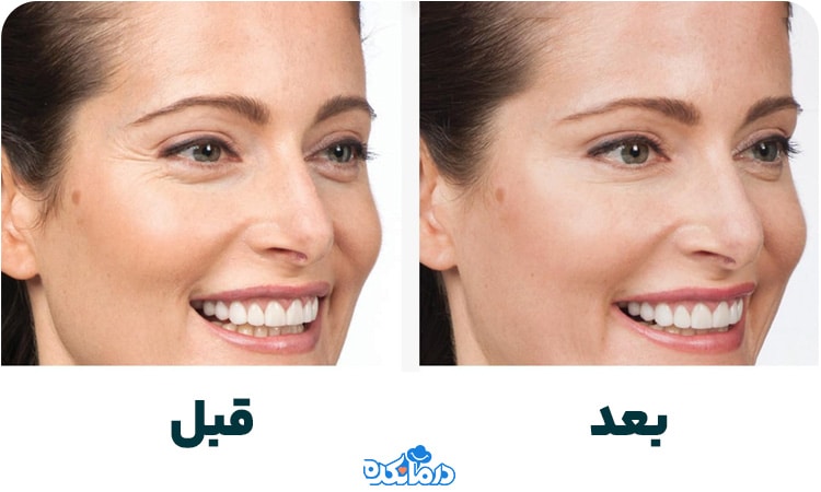 تصویر قبل و بعد لیفت‌شقیقه با بوتاکس