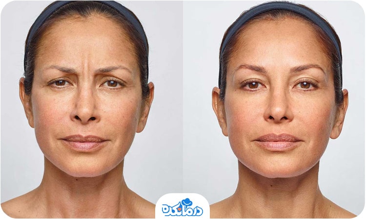 چهره فردی قبل از و بعد از تزریق بوتاکس دیستون