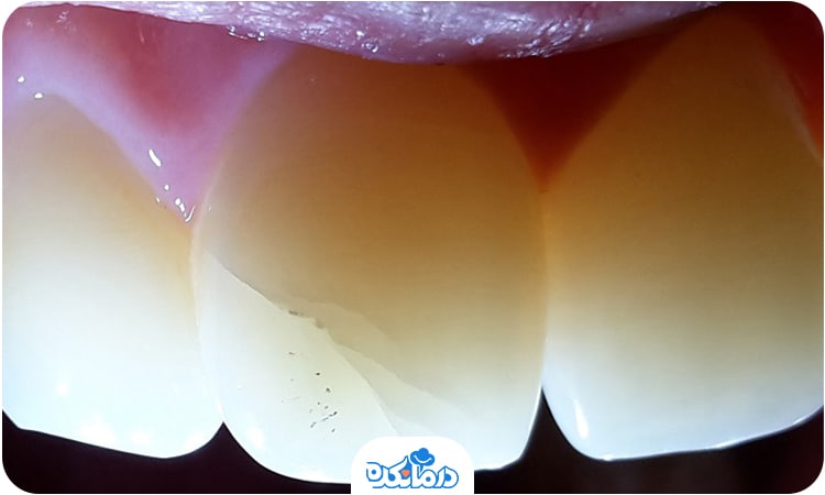 تصویر دندان دارای ترک خوردگی